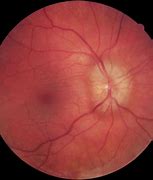 Image result for Enlarged Optic Nerve