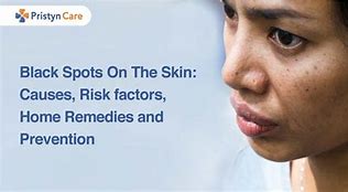 Image result for Black Spots On Skin Means