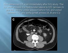 Image result for Retrocaval Ureter vs Normal