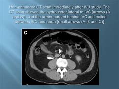 Image result for Retrocaval Ureter X-ray