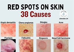 Image result for Dark Red Spots On Skin