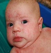 Image result for Baby Eczema Hands