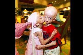 Image result for Progeria