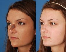 Image result for Trim Skin Lesion