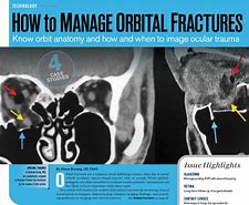 Image result for Orbital Rim Fracture