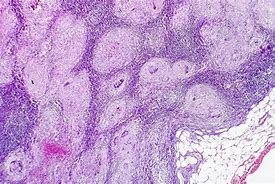 Image result for Necrosis Histology