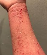 Image result for Eczema On Darker Skin