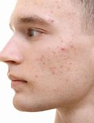 Image result for People with Pimples