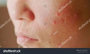 Image result for Acne On Side of Face