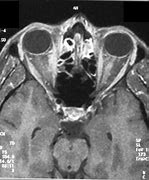 Image result for Enlarged Optic Nerve