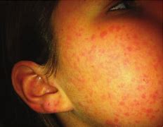 Image result for Vasculitis On Face