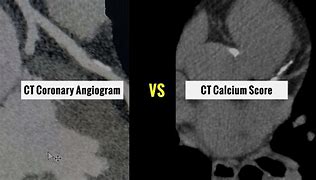 Image result for Coronary CT Angiography CTA