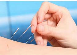 Image result for Acupuncture