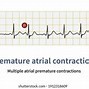 Image result for Premature Atrial Contraction