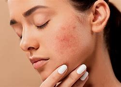 Image result for Pimple Face Lady