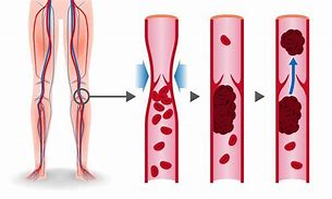 Image result for SCV Thrombosis