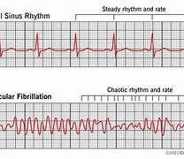 Image result for Ventricular Fibrillation Symptom