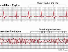 Image result for AFib vs V-fib