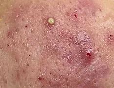 Image result for Lower Leg Pustules