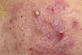 Image result for Large Acne Pustules