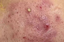 Image result for Pustules and Inflammatory Acne