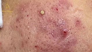 Image result for Pustules and Inflammatory Acne