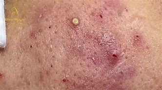 Image result for Infected Acne Pustules