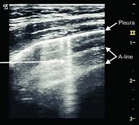 Image result for Lung Ultrasound B Lines Pulmonary Edema