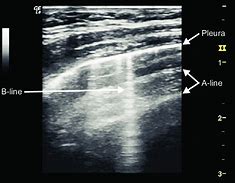 Image result for B Lines Chest Ultrasound