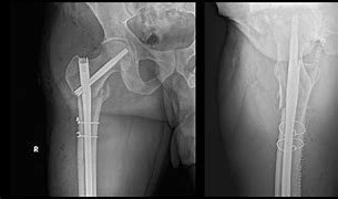 Image result for Orif Hip