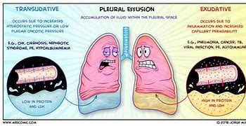 Image result for Pleural Infection