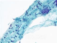 Image result for Adrenal Cytology