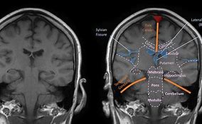 Image result for Coronal Plane Brain MRI