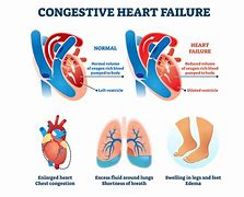 Image result for Right Heart Failure ECG