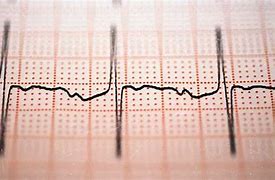 Image result for AFib Heart