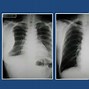 Image result for Thoracic Empyema On Percussion