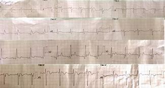 Image result for RVH ECG