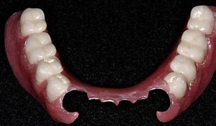 Image result for Bottom Dentures