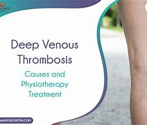 Image result for Venous Thrombosis