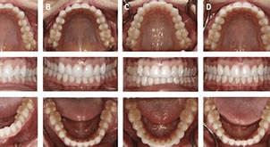 Image result for Propel Tooth Movement