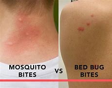 Image result for Baby Bed Bug Bites