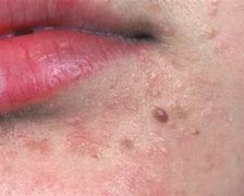 Image result for Flat Skin Warts