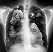 Image result for Lung Asthetic