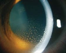 Image result for Uveitis Eye Disease