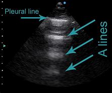 Image result for Lung Ultrasound Probe