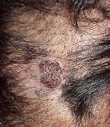 Image result for Verrucous Carcinoma