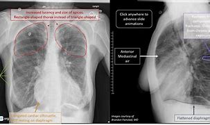 Image result for Legs Emphysema X-ray