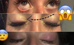 Image result for EyeLashes Infection