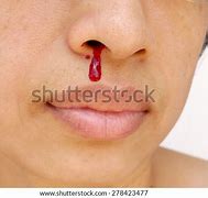 Image result for African Nose Bleed