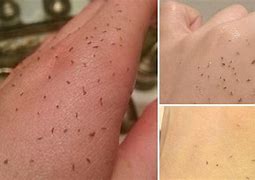 Image result for Blackhead Removal Before and After